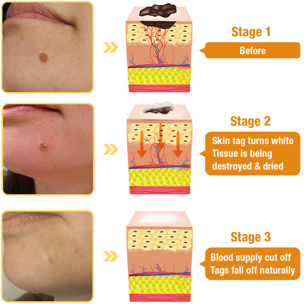 đ„Final 3 Hours: 80% OFF - LBMLBMâą TagRecede Bee Venom Treatment Spray